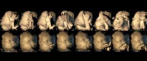 Rauchen in der Schwangerschaft: Ultraschallbild