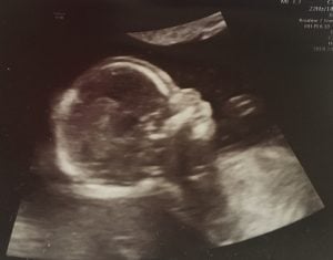 Ultraschallbild eines Babys aus dem Ersttrimesterscreening
