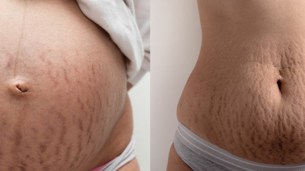 Endlich! Diese Mama enthüllt die Tricks scheinbar perfekter After-Baby-Bodys