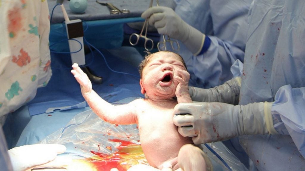 Faszinierendes Video: Das passiert beim Kaiserschnitt wirklich
