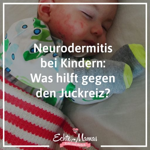 Neurodermitis bei Kinder