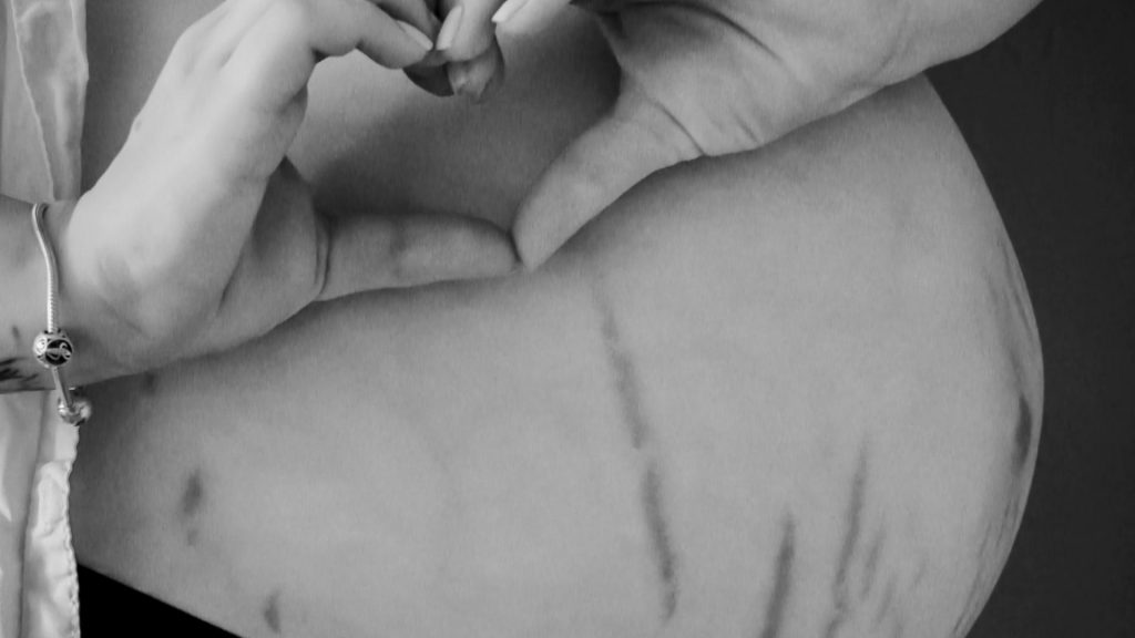 Dehnungsstreifen: Liebe Mamas, liebt euch so, wie ihr seid!
