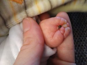 Dysmelie bei Babys: die kleine Mia kam mit einer Handfehlbildung zur Welt