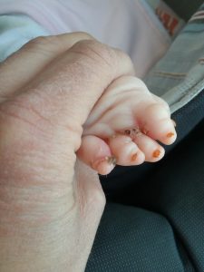 Dysmelie bei Babys: Mias Finger nach der ersten OP