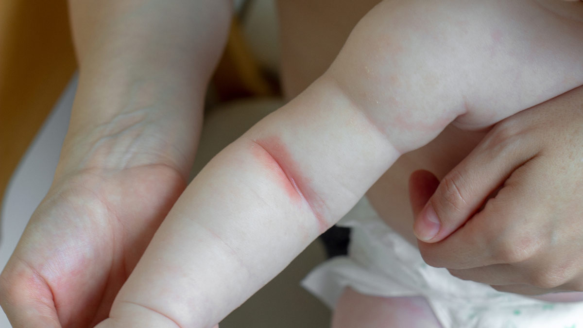 kind-mit-neurodermitis-trockene-haut - Echte Mamas