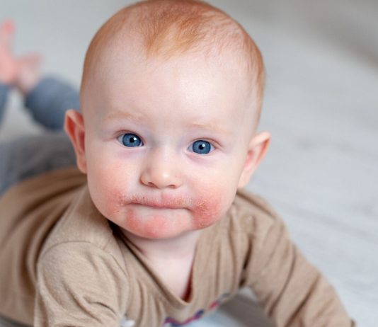 Allergien beim Baby zeigen sich oft mit Hautausschlag