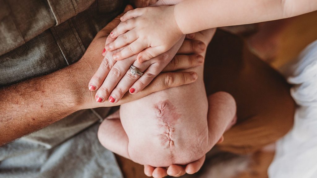 Spina bifida. Was die Diagnose „offener Rücken“ für unser Baby und uns bedeutet