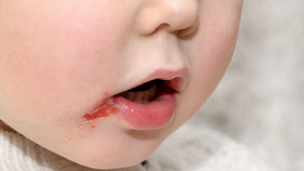 Herpes beim Baby: So erkennst du es!