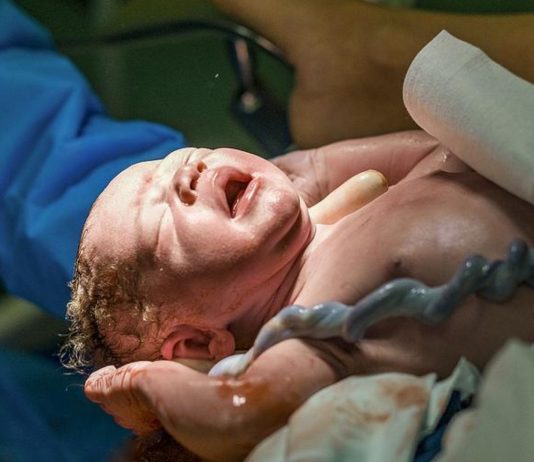 Bei einer normalen Geburt kommen die Babys ohne Nabeschnur um den Hals zur Welt.