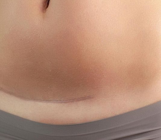 Ein Kaiserschnitt hinterlässt bei vielen Frauen nicht nur körperliche Spuren.