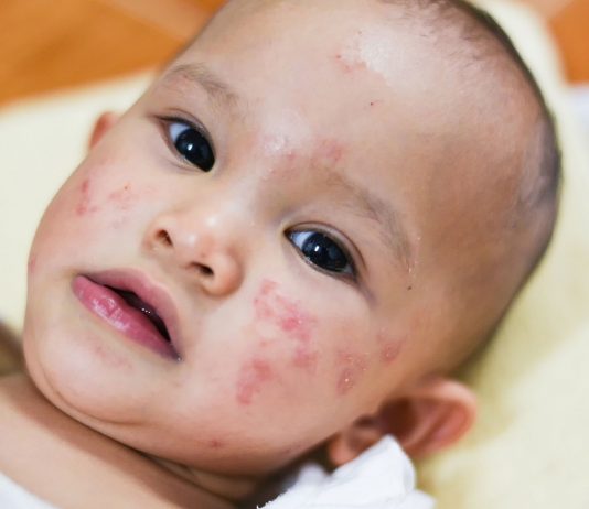 Wenn dein Baby eine Unverträglichkeit hat, kann Hautausschlag ein Symptom sein.