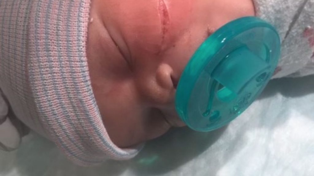 Tiefe Wunde im Baby-Gesicht nach Kaiserschnitt: Was eine Ärztin dazu sagt