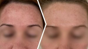 *Anwendung der ANTI-PIGMENT Pflegeroutine, individuelle Ergebnisse können abweichen.