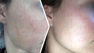 *Anwendung der ANTI-PIGMENT Pflegeroutine, individuelle Ergebnisse können abweichen.