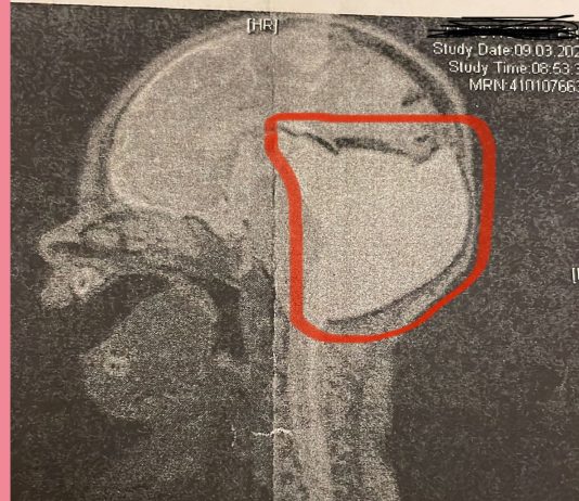 Eine große Zyste verdrängte bei Jessies Tochter Teile des Gehirns im Mutterleib. Foto: Privat