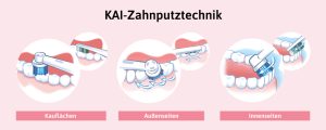 Zähneputzen nach der KAI-Methode.