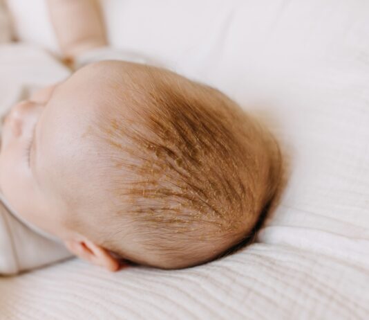 Schuppige Haut auf Babys Kopf kann erst einmal zur Verunsicherung führen. Wir haben Tipps für dich!