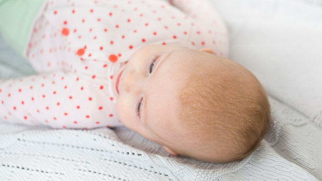 Wenn Babys Kopfhaut schuppt: Ist es Kopfgneis oder Milchschorf?