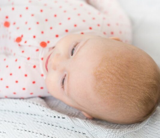 Baby Kopfhaut mit Schuppen - Kopfhaut oder Milchschorf?