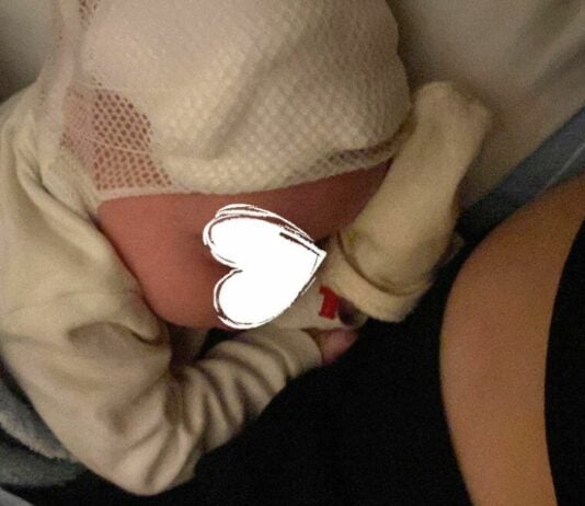 Stefanies kleine Tochter kam mit einem Wasserkopf zur Welt.