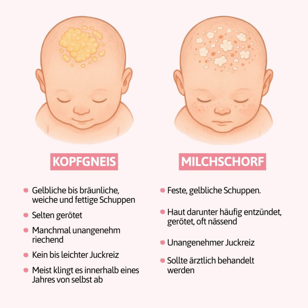Grafische Darstellung der Unterschiede zwischen Kopfgneis und Milchschorf anhand eines Babykopfes.