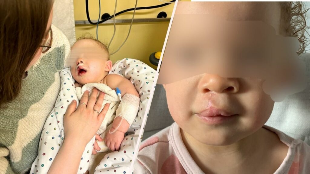 Lippen-Kieferspalte: „Bitte behandelt meine Tochter nicht anders!“