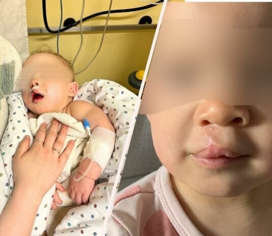 Jills Tochter kam mit einer Lippen-Kieferspalte zur Welt - heute ist davon nur noch eine kleine Narbe geblieben.