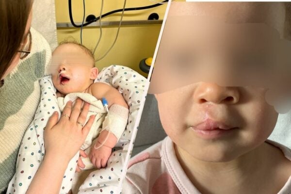 Jills Tochter kam mit einer Lippen-Kieferspalte zur Welt - heute ist davon nur noch eine kleine Narbe geblieben.